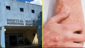 Hospital de Chillán confirma 13 casos de sarna noruega y activa medidas para contener el brote